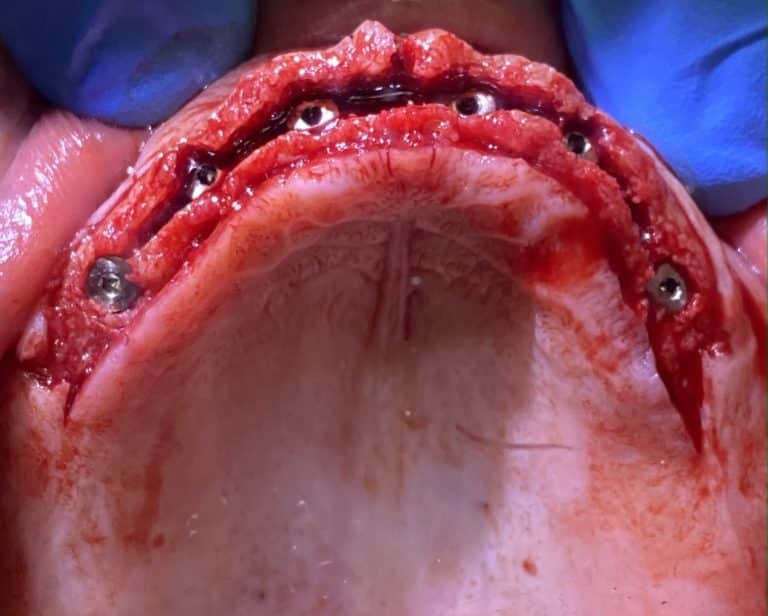 After Image: *Graphic Images* Ridge Splitting Procedure and Bone Expansion with 6 Implant Placements and Upper Full-Arch Fixed Screw-Retained All-on-6 Hybrid Implant Prosthesis - other