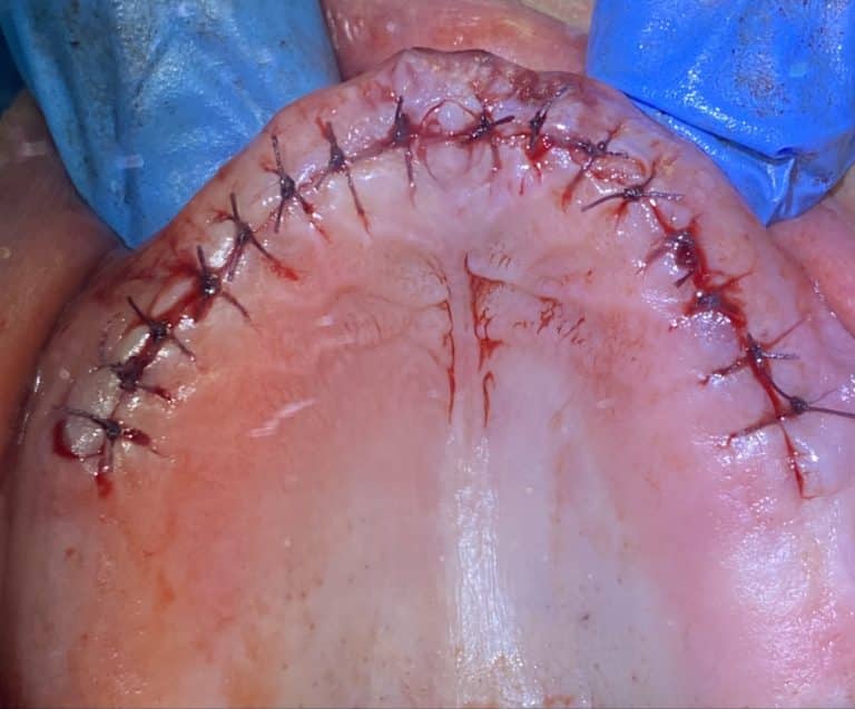 After Image: *Graphic Images* Ridge Splitting Procedure and Bone Expansion with 6 Implant Placements and Upper Full-Arch Fixed Screw-Retained All-on-6 Hybrid Implant Prosthesis - front