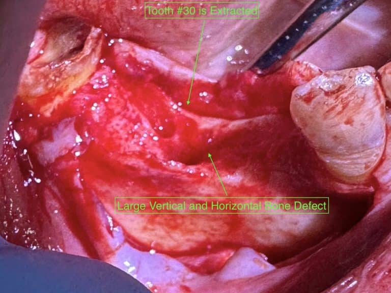 After Image: *Graphic Images* Vertical and Horizontal Ridge Augmentation utilizing Autogenous Bone Block Graft Harvested from the Jaw - front
