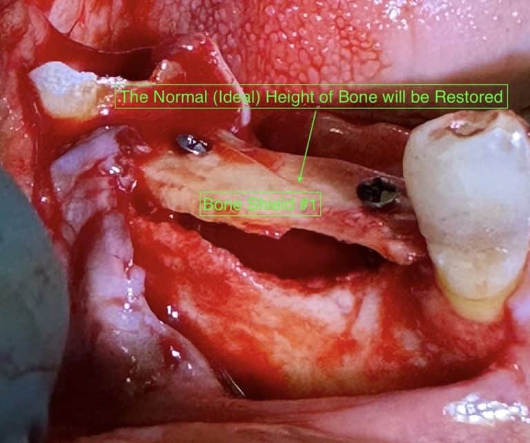 After Image: *Graphic Images* Vertical and Horizontal Ridge Augmentation utilizing Autogenous Bone Block Graft Harvested from the Jaw - front
