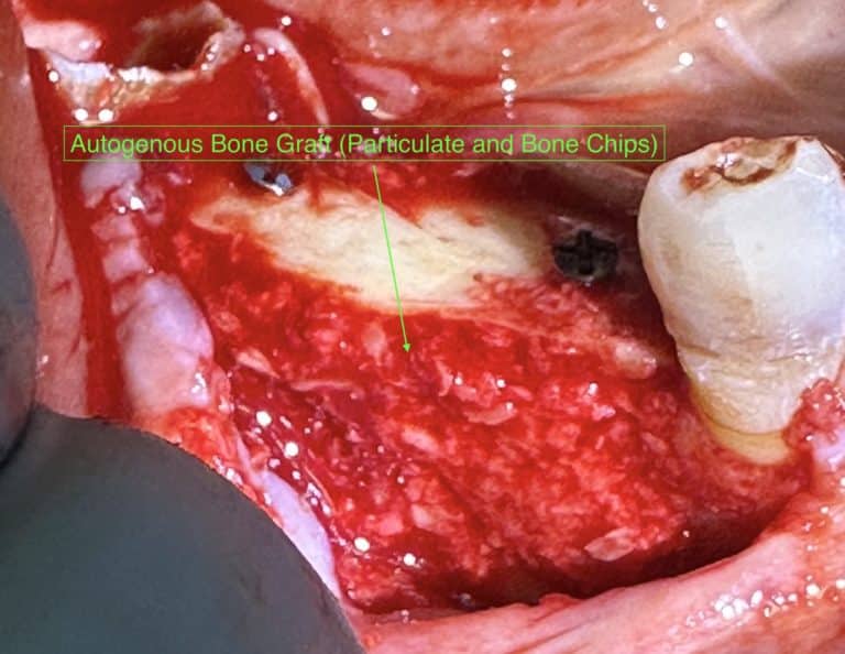 After Image: *Graphic Images* Vertical and Horizontal Ridge Augmentation utilizing Autogenous Bone Block Graft Harvested from the Jaw - front