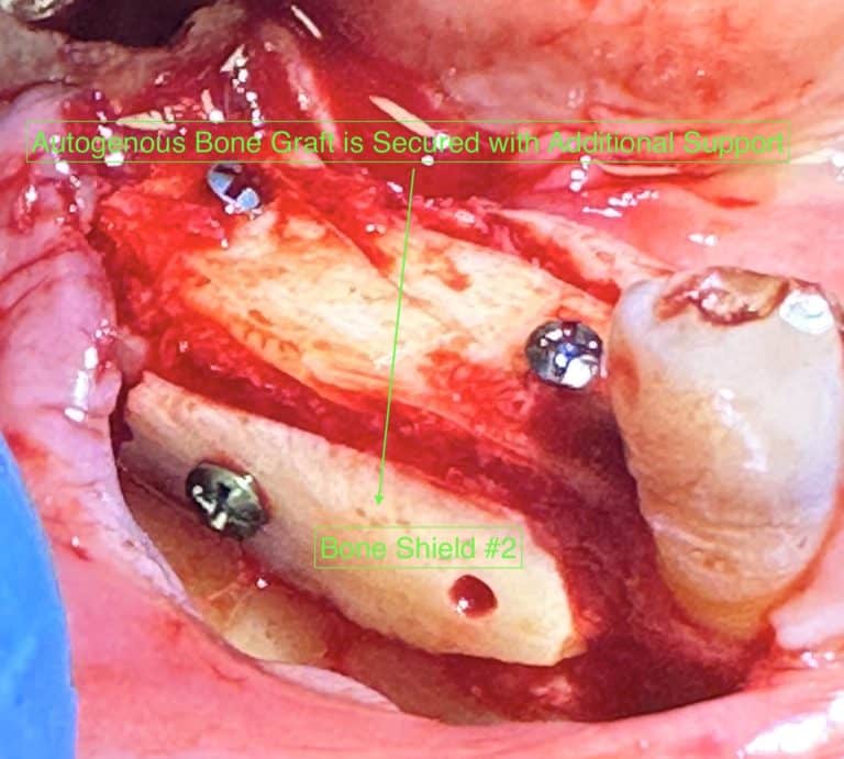 After Image: *Graphic Images* Vertical and Horizontal Ridge Augmentation utilizing Autogenous Bone Block Graft Harvested from the Jaw - front