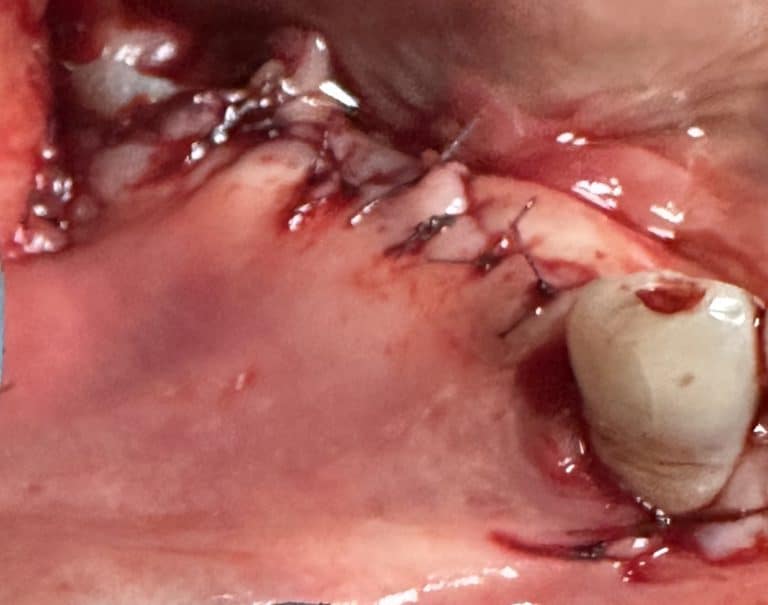 After Image: *Graphic Images* Vertical and Horizontal Ridge Augmentation utilizing Autogenous Bone Block Graft Harvested from the Jaw - front