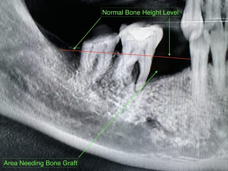 Before Image: *Graphic Images* Vertical and Horizontal Ridge Augmentation utilizing Autogenous Bone Block Graft Harvested from the Jaw - front