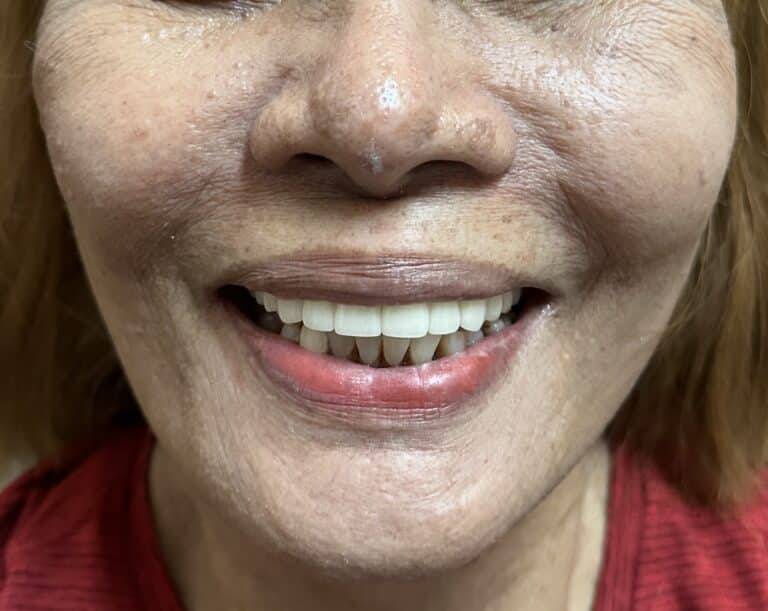 After Image: Full-Arch FP-1 Fixed Zirconia Bridge Prosthesis with 10 implants in the Upper Arch - front