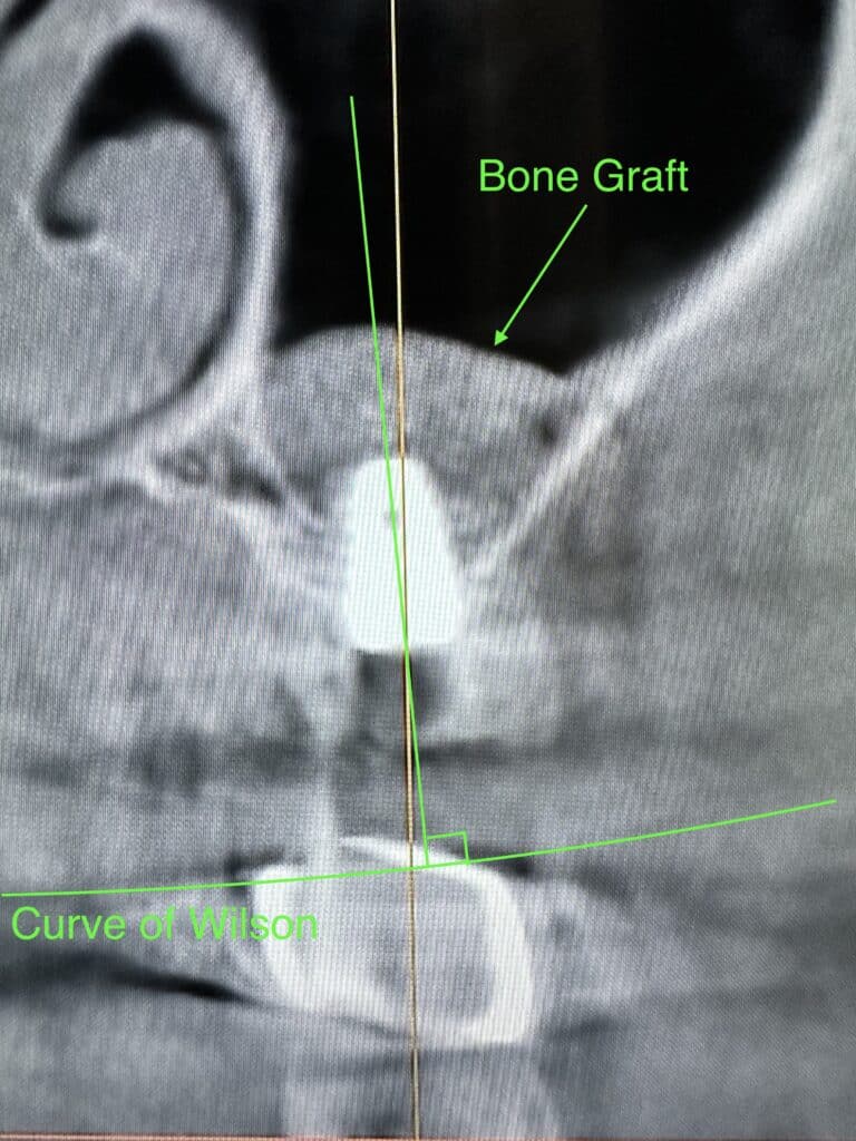 After Image: Sinus Lift via Lateral Window Approach with Immediate Implant Placement - front