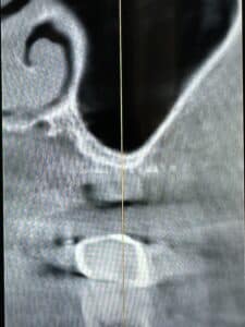 Sinus Lift via Lateral Window Approach with Immediate Implant Placement