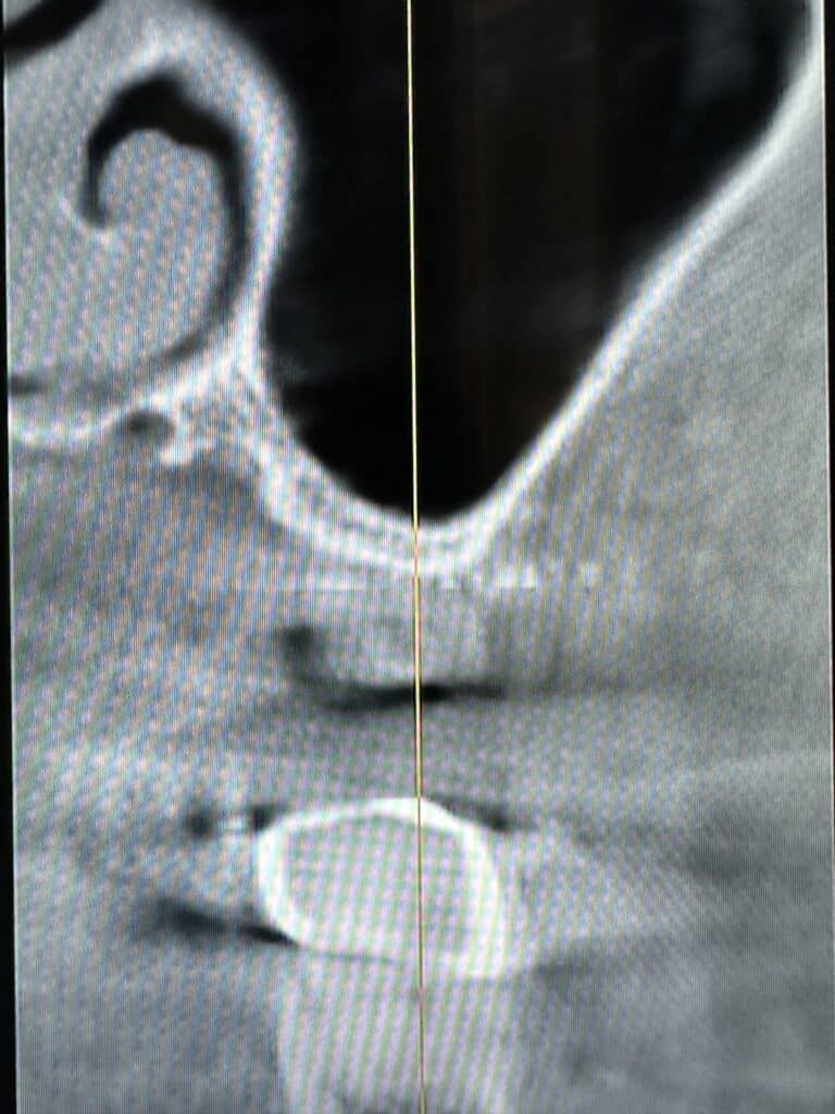Before Image: Sinus Lift via Lateral Window Approach with Immediate Implant Placement - front