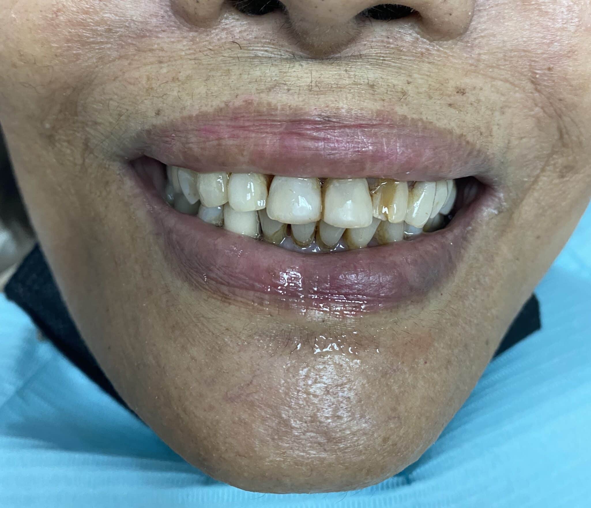 Full-Arch FP-1 Fixed Oral Zirconia Bridge Prosthesis with 10 implants in the Upper Arch