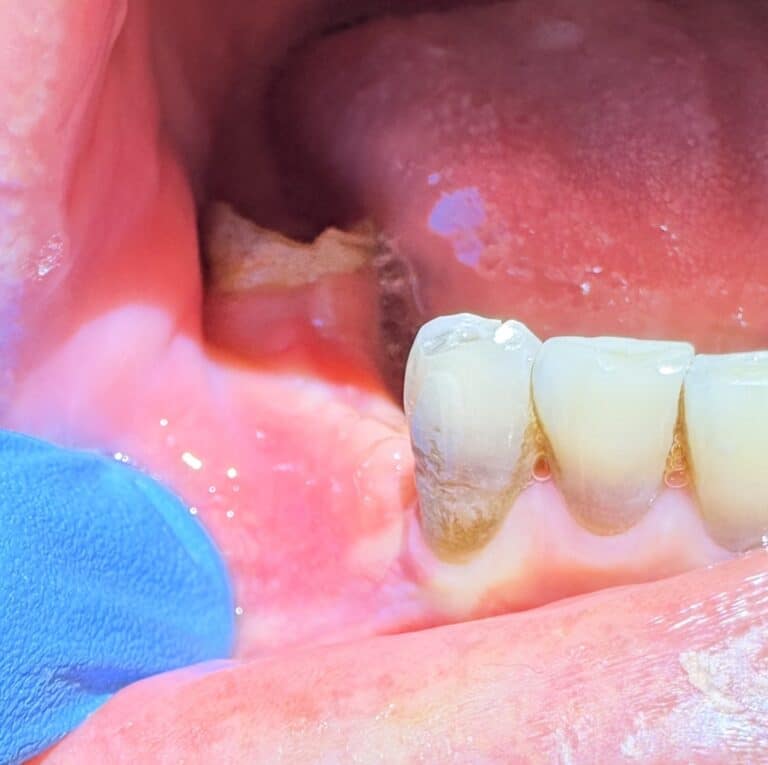 After Image: *Graphic Images* Vertical and Horizontal Ridge Augmentation utilizing Autogenous Bone Block Graft Harvested from the Jaw - front