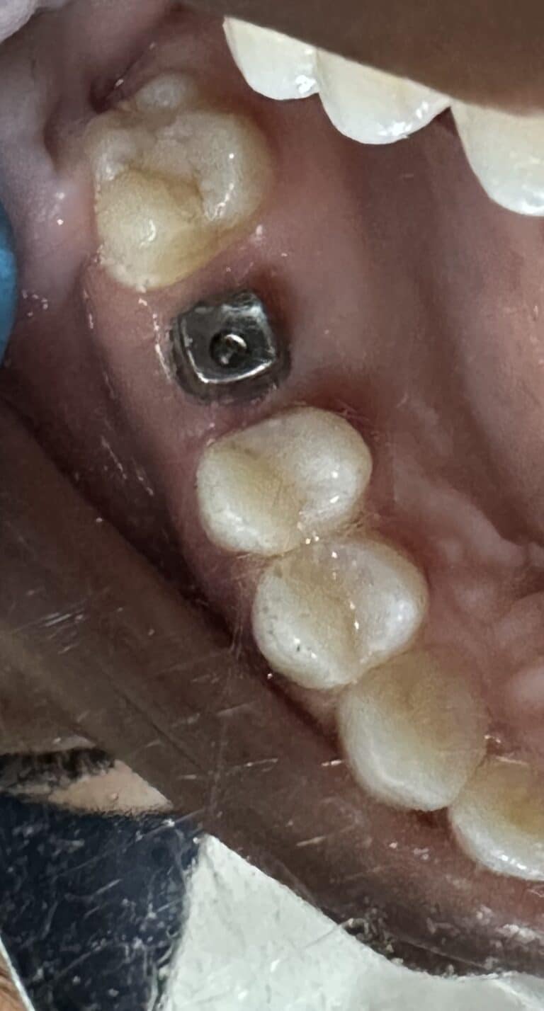 After Image: Sinus Lift via Lateral Window Approach with Immediate Implant Placement - front