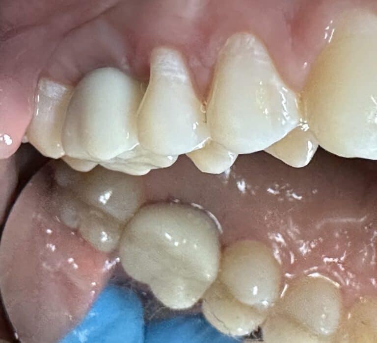 After Image: Sinus Lift via Lateral Window Approach with Immediate Implant Placement - front