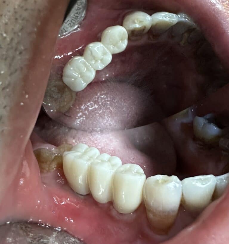 After Image: *Graphic Images* Vertical and Horizontal Ridge Augmentation utilizing Autogenous Bone Block Graft Harvested from the Jaw - front