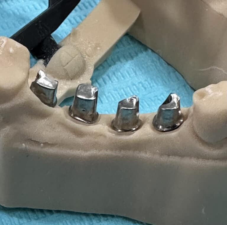 After Image: *Graphic Image* Ridge Splitting Expansion Procedure with 4 Implant Placements in the Lower Right Posterior Quadrant - front