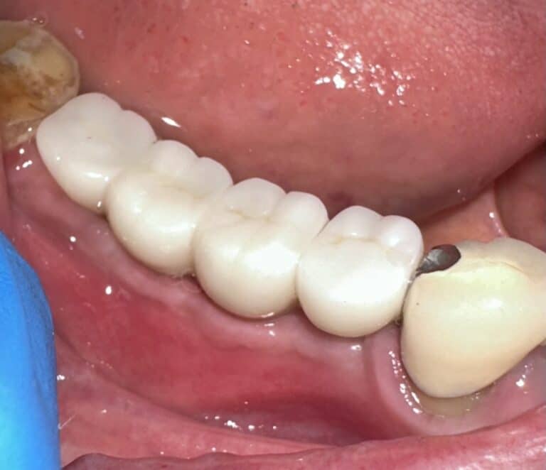After Image: *Graphic Image* Ridge Splitting Expansion Procedure with 4 Implant Placements in the Lower Right Posterior Quadrant - front