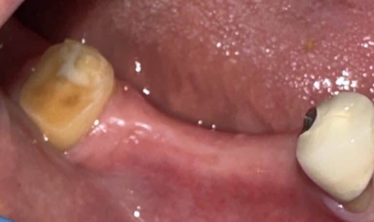 Before Image: *Graphic Image* Ridge Splitting Expansion Procedure with 4 Implant Placements in the Lower Right Posterior Quadrant - front