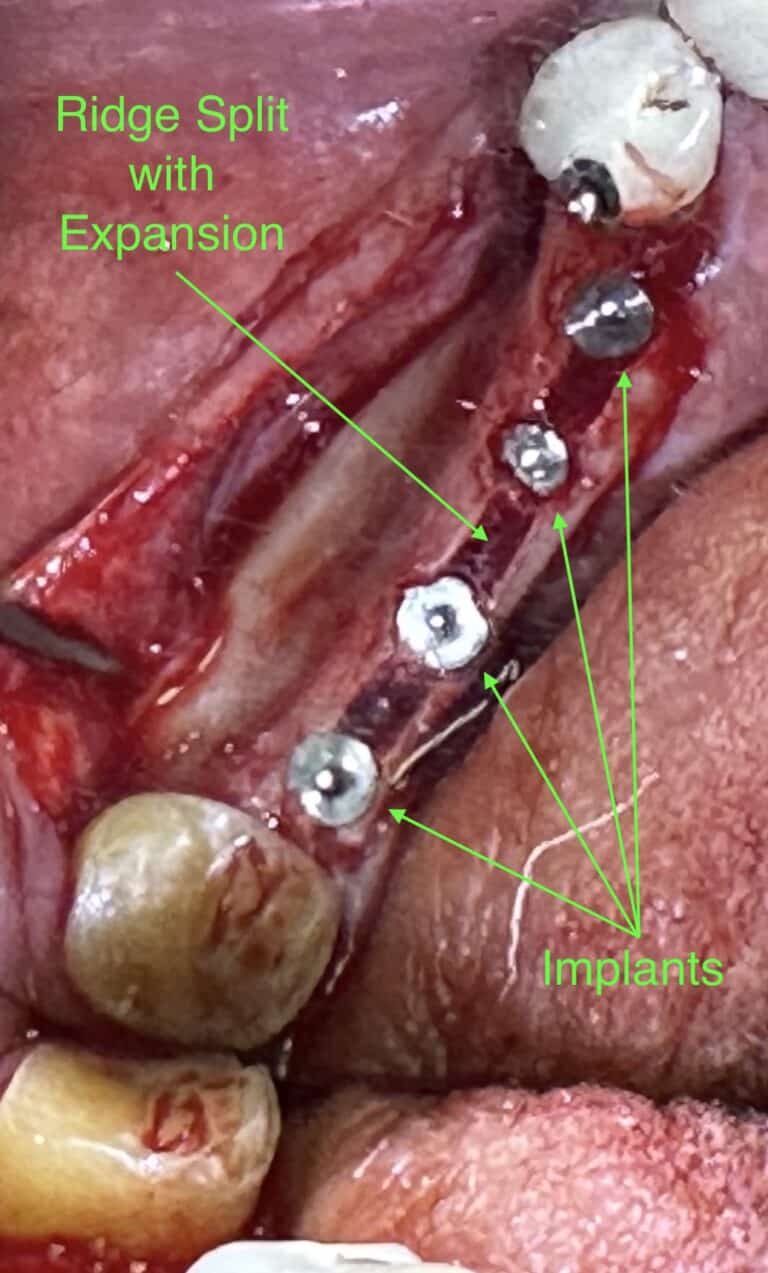 After Image: *Graphic Image* Ridge Splitting Expansion Procedure with 4 Implant Placements in the Lower Right Posterior Quadrant - front