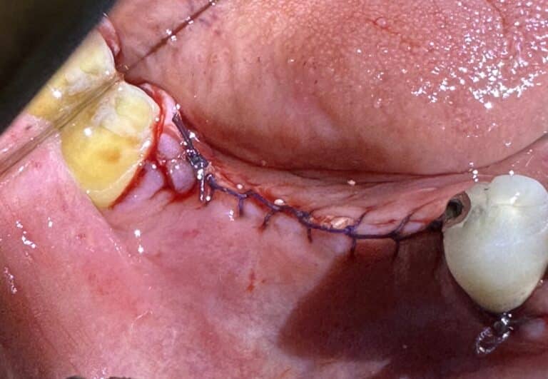After Image: *Graphic Image* Ridge Splitting Expansion Procedure with 4 Implant Placements in the Lower Right Posterior Quadrant - front