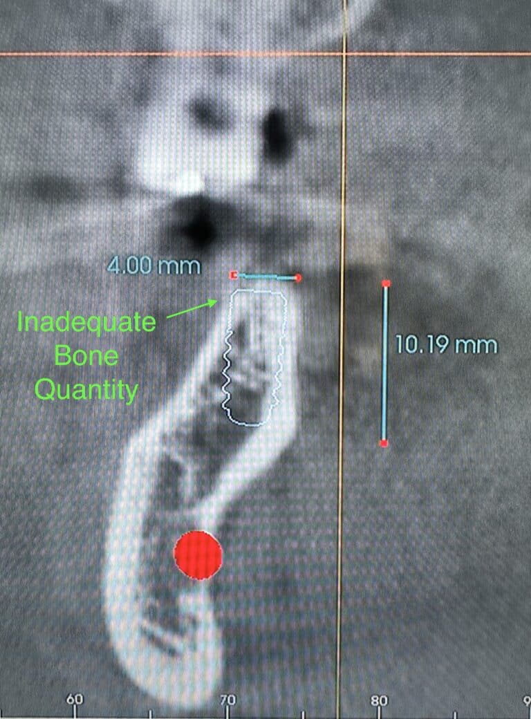 Before Image: *Graphic Image* Ridge Splitting Expansion Procedure with 4 Implant Placements in the Lower Right Posterior Quadrant - front