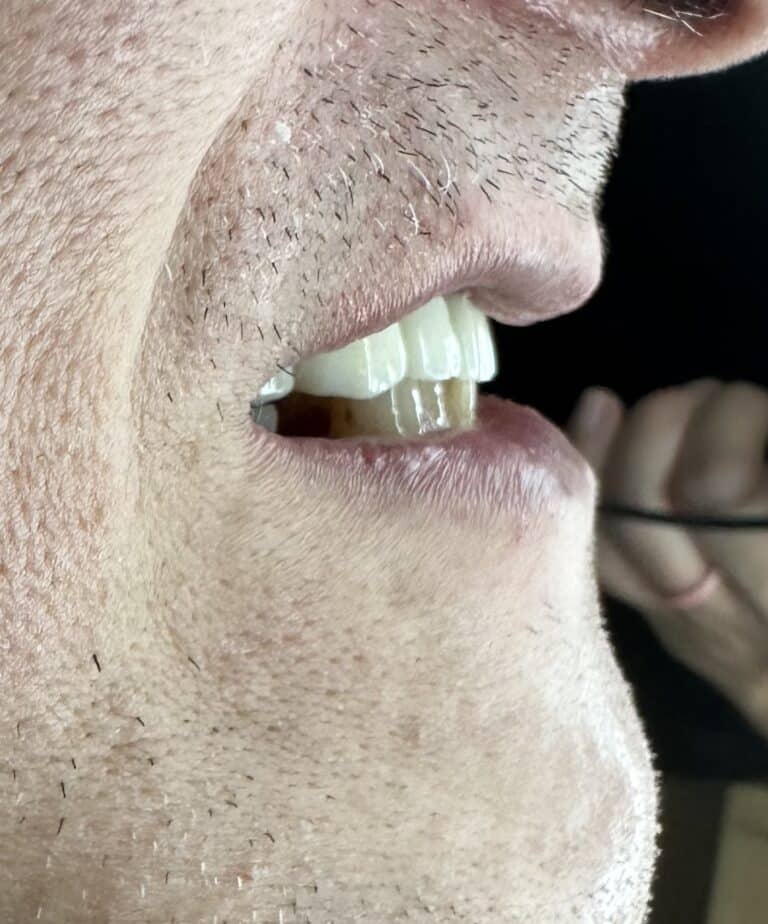 After Image: Full-Arch Fixed and Screw-Retained FP-1 (Tooth-Only Defect) Implant Zirconia Prosthesis - right-side