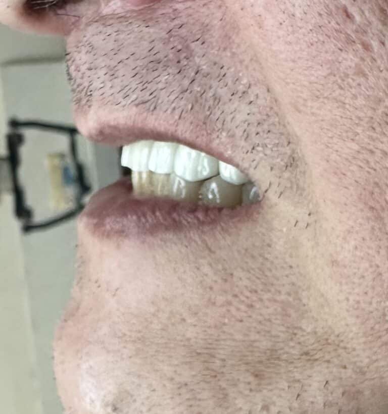 After Image: Full-Arch Fixed and Screw-Retained FP-1 (Tooth-Only Defect) Implant Zirconia Prosthesis - front