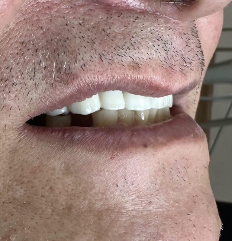 After Image: Full-Arch Fixed and Screw-Retained FP-1 (Tooth-Only Defect) Implant Zirconia Prosthesis - right-front-oblique