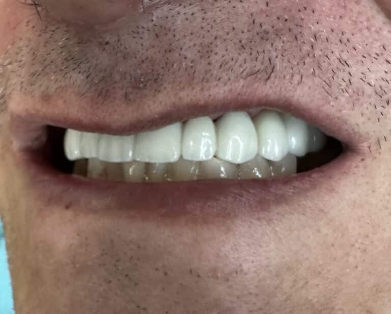 After Image: Full-Arch Fixed and Screw-Retained FP-1 (Tooth-Only Defect) Implant Zirconia Prosthesis - left-front-oblique