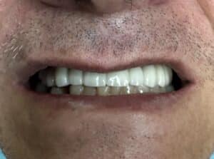 Full-Arch Fixed and Screw-Retained FP-1 (Tooth-Only Defect) Implant Zirconia Prosthesis