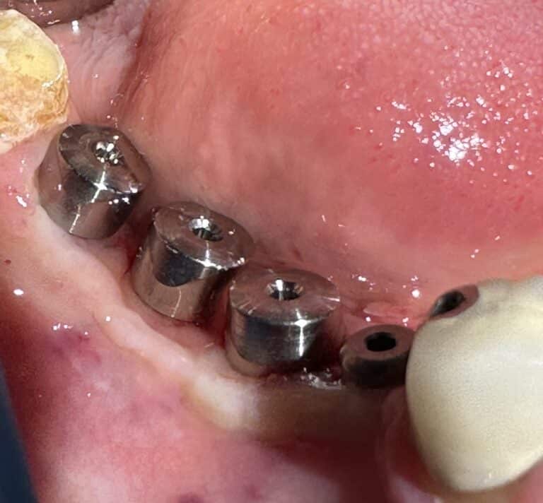 After Image: *Graphic Image* Ridge Splitting Expansion Procedure with 4 Implant Placements in the Lower Right Posterior Quadrant - front