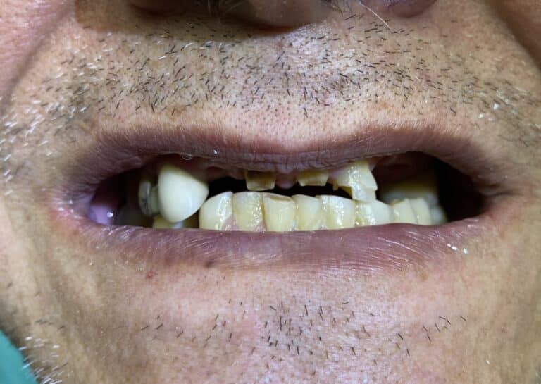 Before Image: Full-Arch Fixed and Screw-Retained FP-1 (Tooth-Only Defect) Implant Zirconia Prosthesis - front