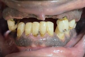 Before Image: Full-Arch Upper Fixed Screw-Retained FP-3 (Composite Defect) Implant Prosthesis