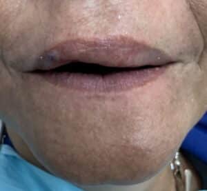 Before Image: Upper Full-Arch Fixed Screw-Retained Full Zirconia FP-1 (Tooth-Only Defect) Implant Prosthesis