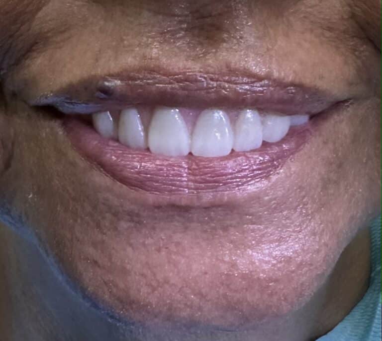 After Image: *Graphic Images* Ridge Splitting Procedure and Bone Expansion with 6 Implant Placements and Upper Full-Arch Fixed Screw-Retained All-on-6 Hybrid Implant Prosthesis - other