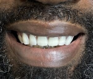 After Image: Full-Arch Upper Fixed Screw-Retained FP-3 (Composite Defect) Implant Prosthesis