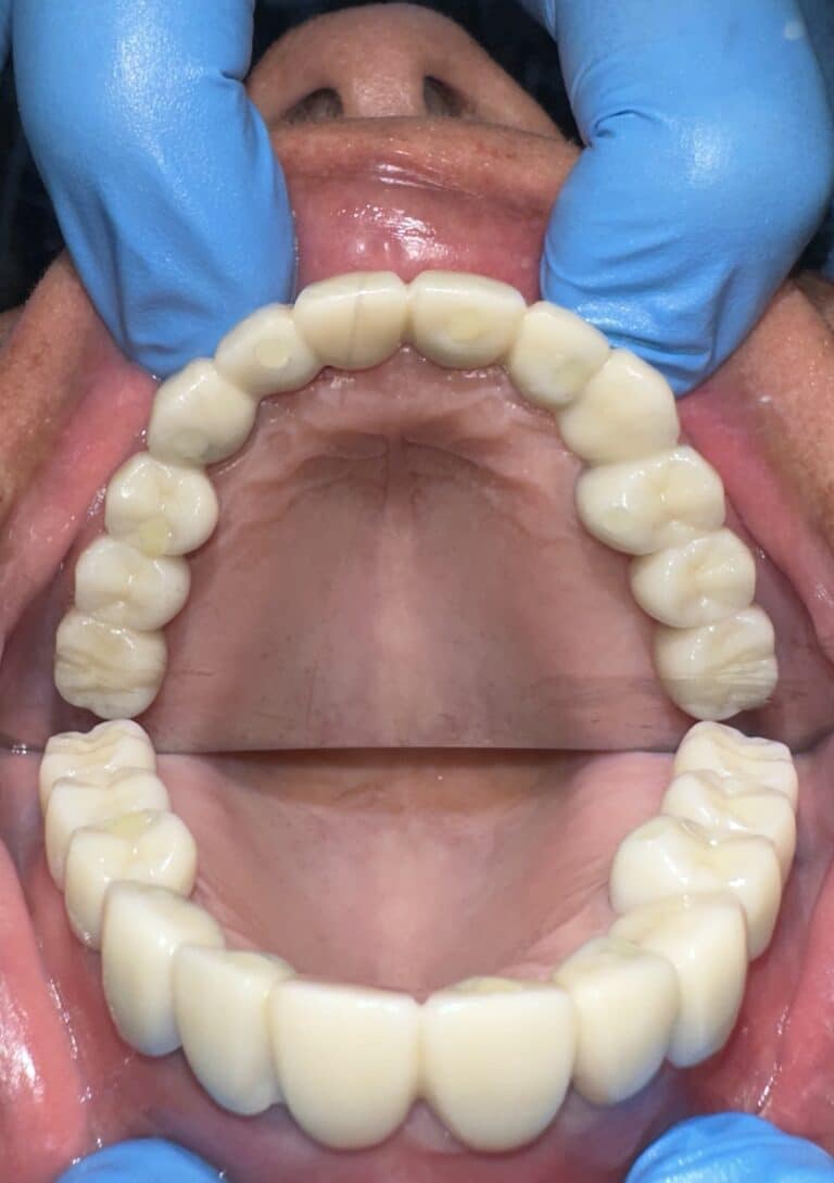 After Image: Upper Full-Arch Fixed Screw-Retained Full Zirconia FP-1 (Tooth-Only Defect) Implant Prosthesis - front