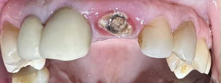 Before Image: Extraction of Broken Tooth with Same Day Placement of Implant and Temporary Crown - front