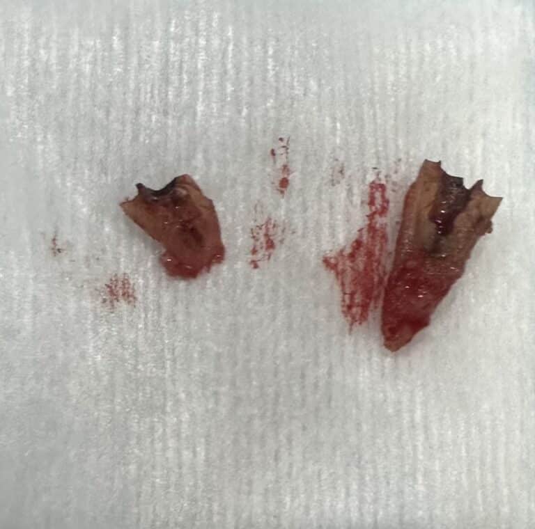 Before Image: Extraction of Broken Tooth with Same Day Placement of Implant and Temporary Crown -