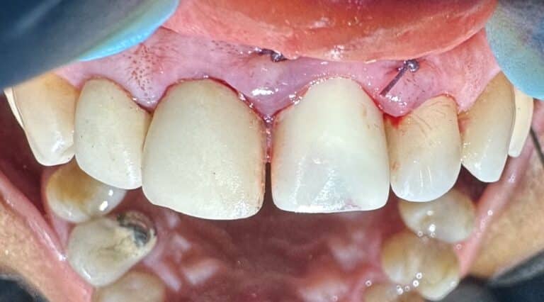 After Image: Extraction of Broken Tooth with Same Day Placement of Implant and Temporary Crown - front