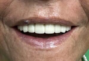 After Image: Upper Full-Arch Fixed Screw-Retained Full Zirconia FP-1 (Tooth-Only Defect) Implant Prosthesis