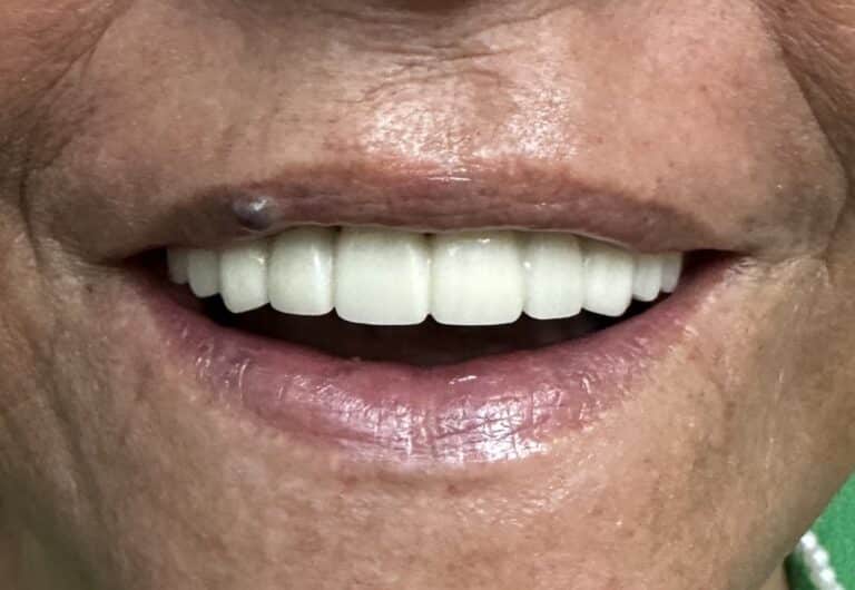 After Image: Upper Full-Arch Fixed Screw-Retained Full Zirconia FP-1 (Tooth-Only Defect) Implant Prosthesis - front