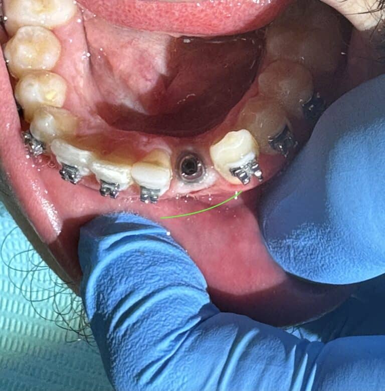 After Image: *Graphic Images* Bone Graft Harvesting and Transplantation from Lower Jaw with Single Implant Placement - front