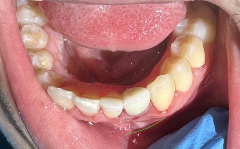 After Image: *Graphic Images* Bone Graft Harvesting and Transplantation from Lower Jaw with Single Implant Placement - front