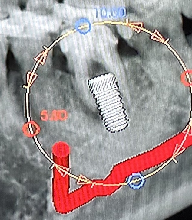 Before Image: Extraction of a Failed Tooth from a Root Canal with an Immediate (Same Day) Placement of an Implant - front