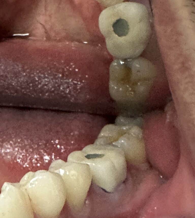 Before Image: Extraction of a Failed Tooth from a Root Canal with an Immediate (Same Day) Placement of an Implant - front