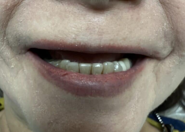 Before Image: Upper Full-Arch Fixed Screw-Retained Hybrid Implant Prosthesis - front