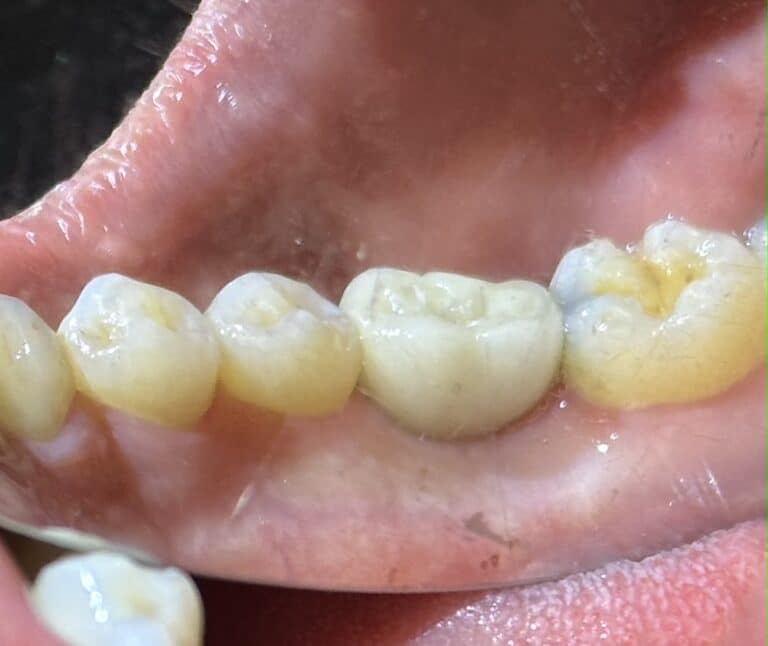 After Image: Extraction of a Failed Tooth from a Root Canal with an Immediate (Same Day) Placement of an Implant - front