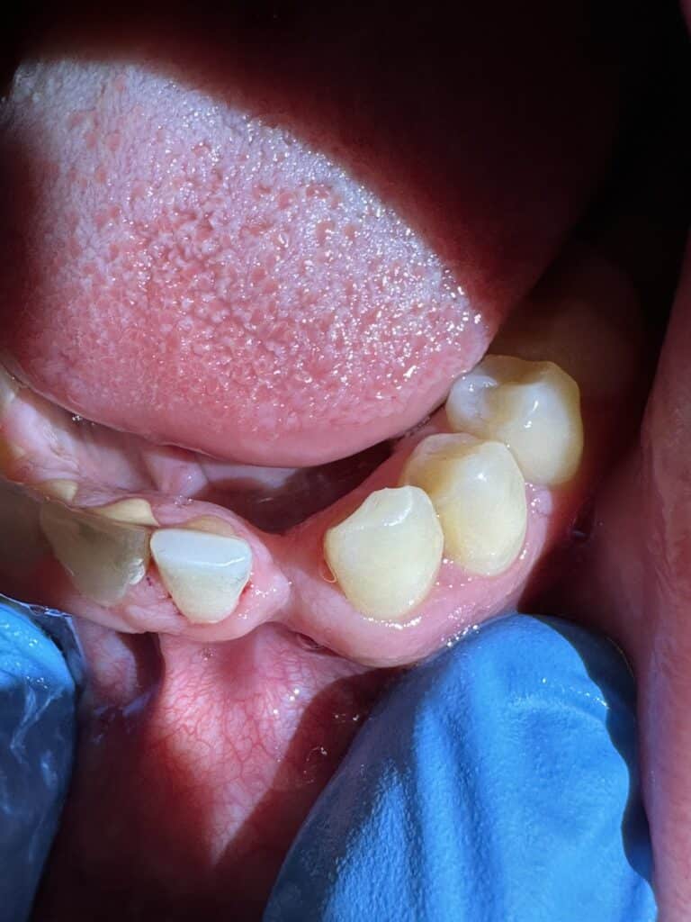 Before Image: *Graphic Images* Bone Graft Harvesting and Transplantation from Lower Jaw with Single Implant Placement - front