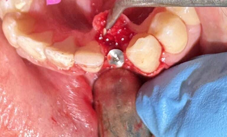 After Image: *Graphic Images* Bone Graft Harvesting and Transplantation from Lower Jaw with Single Implant Placement - front
