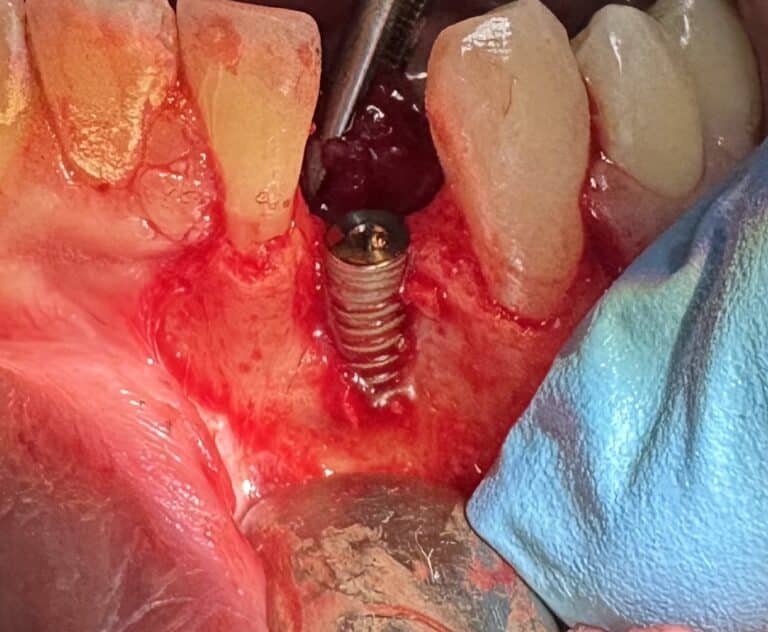 After Image: *Graphic Images* Bone Graft Harvesting and Transplantation from Lower Jaw with Single Implant Placement - front