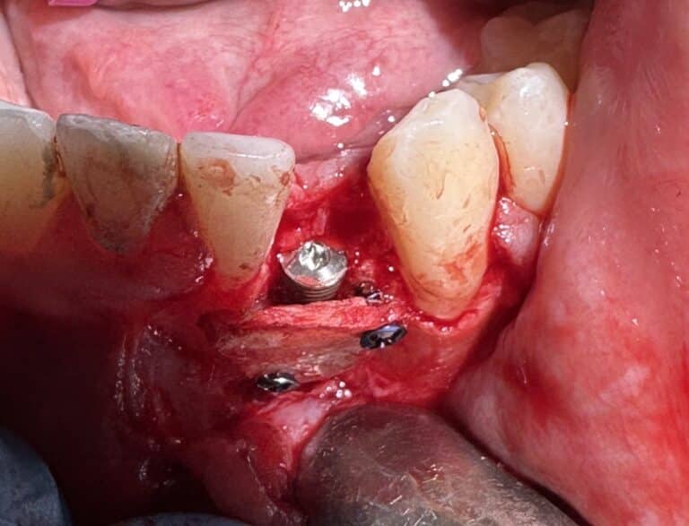 After Image: *Graphic Images* Bone Graft Harvesting and Transplantation from Lower Jaw with Single Implant Placement - front